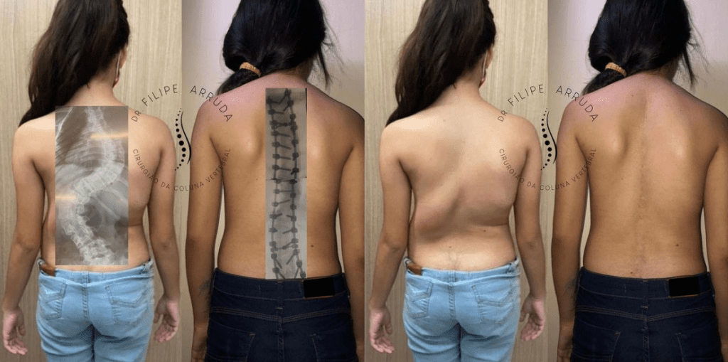 Resultado da Cirurgia de Escoliose do Dr. Filipe Arruda