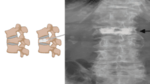 Vertebroplastia: Saiba mais sobre o procedimento para fortalecer vértebras